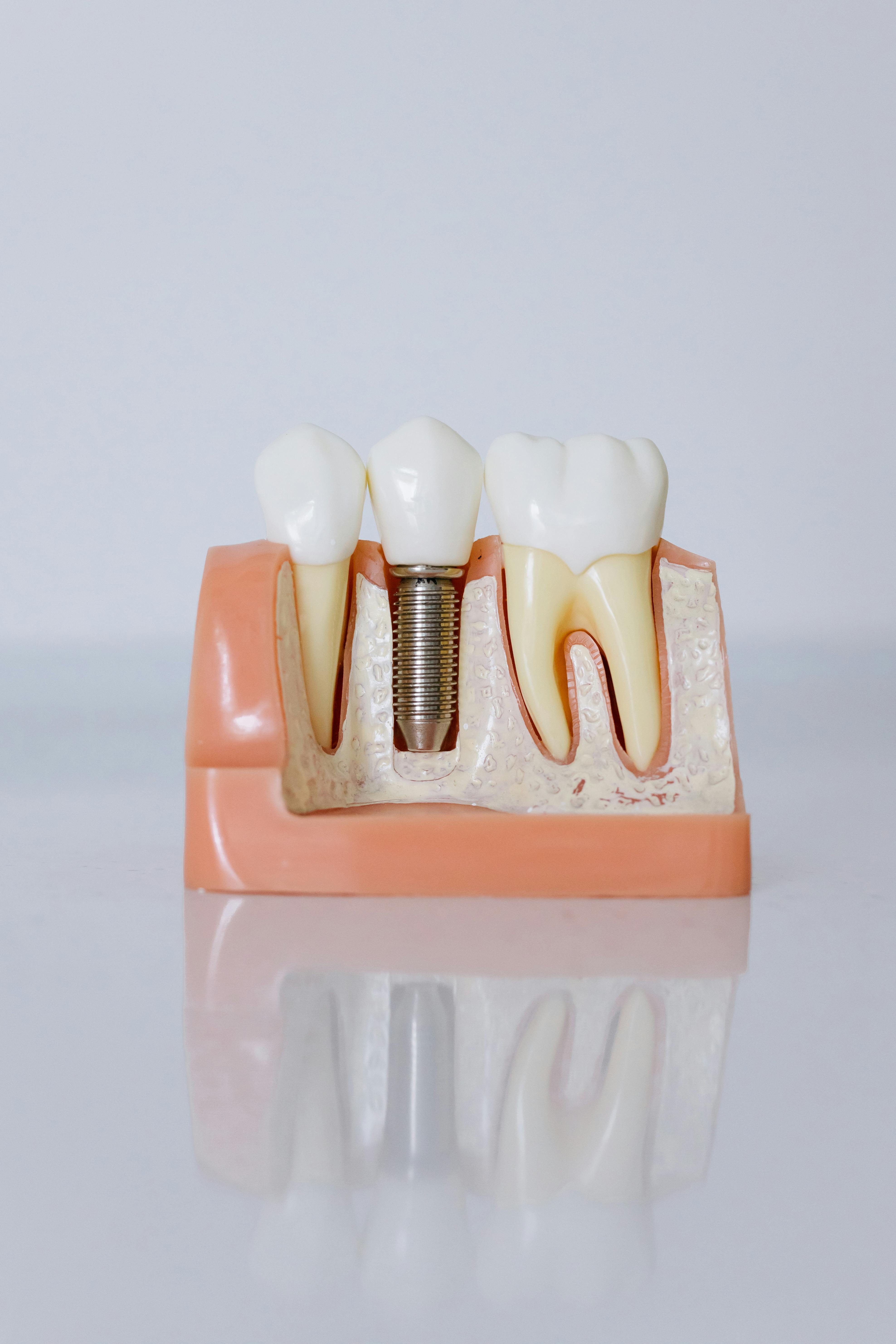 Illustration de la péri-implantite