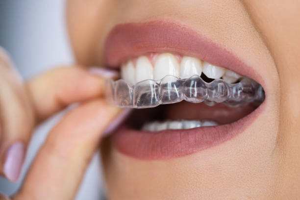 Gouttières transparentes orthodontie